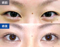 パラレルクイック法