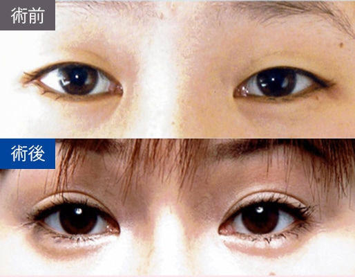 パラレルクイック法