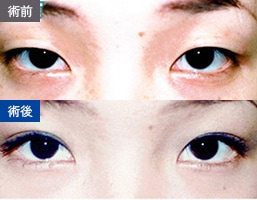 パラレルクイック法