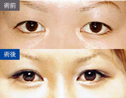 パラレルクイック法