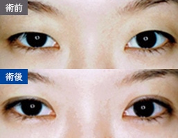 パラレルクイック法