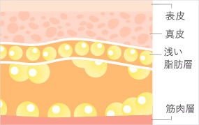 浅い脂肪層一層のみ残し中間～深い脂吸引肪層を除去することで女性らしい曲線を保ったままサイズダウンします