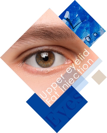 上眼瞼脂肪注入