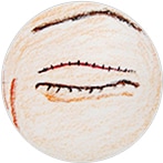 極細の黒ナイロン糸で縫合、抜糸は5日後です