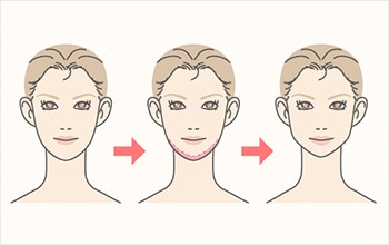 長いアゴ、大きいアゴを小さくしバランスのとれたシャープなアゴへ