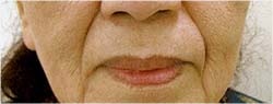 顔全体のたるみが気になる